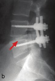 grafilerde füzyon cerrahisi seçenekleri; a) Anterior interbody füzyon (ALIF), b) Posterior interbody füzyon (PLIF), c) Kombine füzyon görülmektedir.