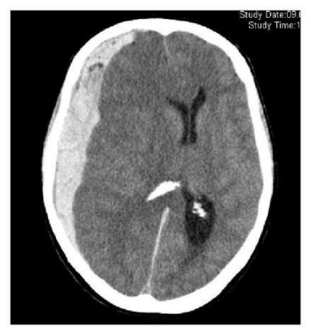 Subdural