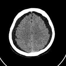 Subdural