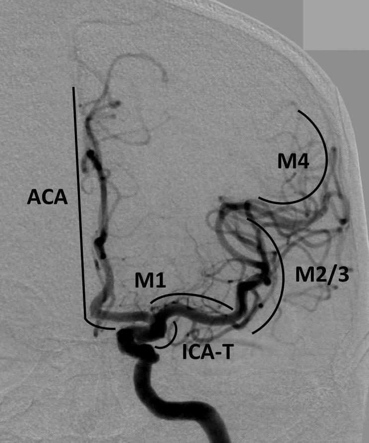 ICAS Akut Tedavi Carotid T Occlusion-M1-Basilar Solitaire 6-30 mm (Medtronic) Trevo 6-25 mm (Stryker) Catch maxi mm(balt)