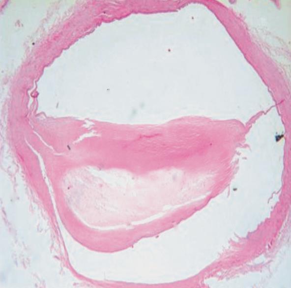 Patogenez Degenere media tabakasında minerallerin (Ca) birikimi görülebilir Plak içindeki yüksek lipit yoğunluğu, neovaskülarizasyon, plak içi hemorajiler, makrofaj ve T lenfosit