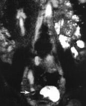 dilatasyon ve distal uçta hipointens tafla ait dolum defekti (ok), ekskretuar MRÜ de (C) sa böbrekte fonksiyon olmad, postkontrastl ve ya bask l T1A SE koronal görüntüde (D) sa böbre in atrofik oldu