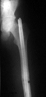 Distal metadiyafizer yerleflimli A2-3 k - r kl dört hastan n birinde 5 valgus aç lanmas yla iyi sonuç al n rken, üç hastada 8-10 valgus aç lanmas yla (bir hastada 8 mm k sal k vard ) orta sonuç al nd