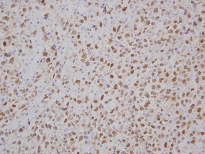 Literatürler göz önüne alınarak, tümör hücrelerinin %20 sinden fazlasında protein tesbit edildiğinde CD 10, bcl-6, mum-1 ekspresyonu pozitif olarak kabul