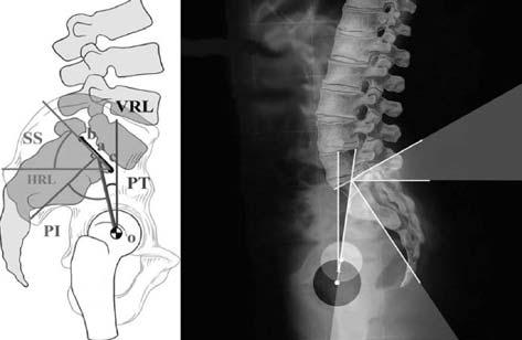 Tonbul ve ark. Hiperkifozda preoperatif spinopelvik parametreler ile düzeltme kayb aras ndaki korelasyon 303 l flmalar ve radyoloji tetkiklerinde bu durumu aç klayacak özellik tespit edilemedi.