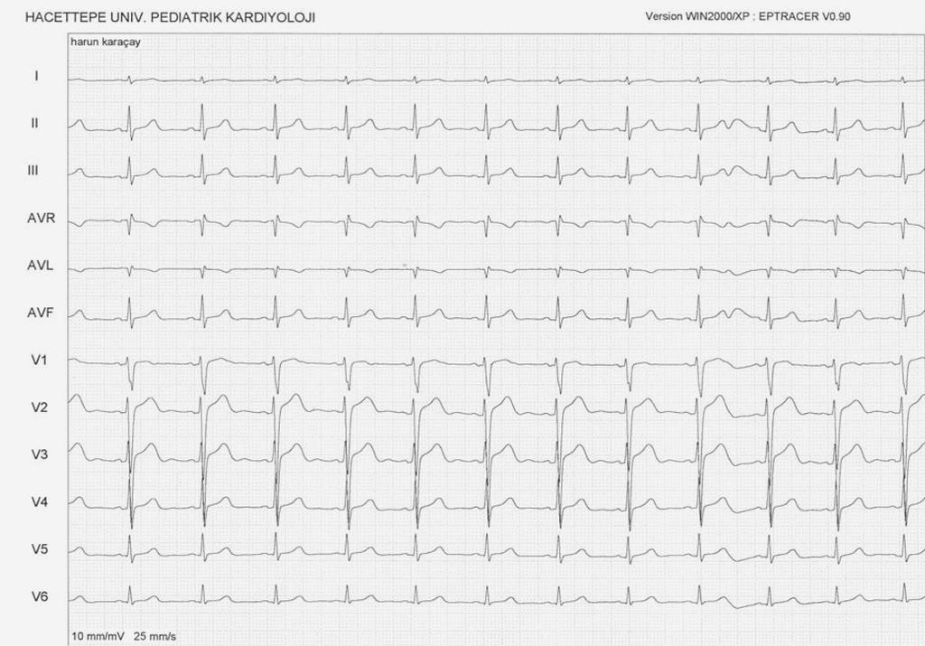 42 Türk Aritmi, Pacemaker ve Elektrofizyoloji Dergisi Olgu Sunumu Daha önceden bilinen bir hastalığı olmayan 14 yaşındaki erkek hasta bölümümüze 17 yaşındaki erkek kardeşinin aniden kaybedilmesi