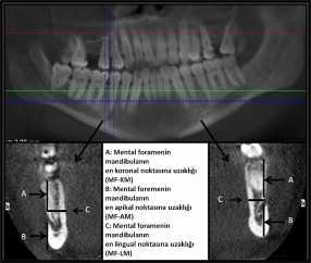 Ertuğrul ve ark. noktasına uzaklığı (MF -AM), mental foramenin mandibulanın en lingual noktasına uzaklığı (MF -LM) ve mental foramenin mandibulanın en koronal noktasına uzaklığı (MF -KM) ölçülmüştür.