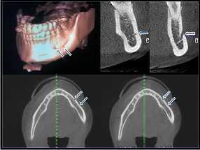 Konik ışınlı bilgisayarlı tomografi (CBCT) üzerinde mental foramenin mandibulanın en apikal noktasına uzaklığı (MF -AM) nın, mental foramenin mandibulanın en lingual noktasına uzaklığı (MF -LM) nın