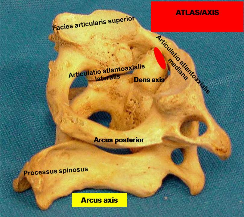 9 Şekil 5: Atlas ve axis arasındaki ilişki. Bu eklemler, başın hareketlerine kayma hareketi yaparak katılır. 1.3. Kraniyoservikal Bölge de Görülen Patolojiler A.