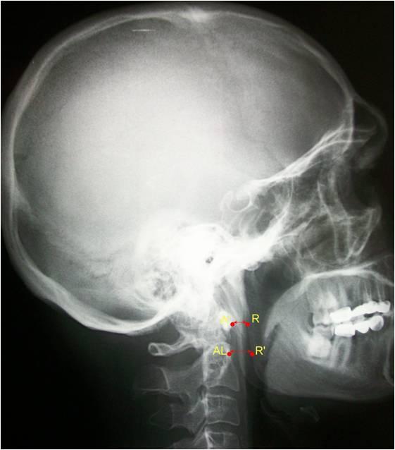 32 Atlas ın tuberculum anterius u ile ramus mandibulae arasındaki mesafe ve axis in korpusu nun ön yüzü ile ramus mandibulae arası mesafe (Dublin ölçümü) ölçüldü (Şekil 9 da R-A ı ve R ı