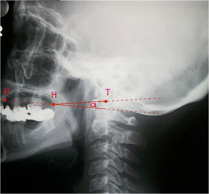 40 Palatum durum un tabanından çekilen bir çizgi ile spina nasalis posterior ve dens axis in tepe noktası çizgisi arasındaki açı (α açısı) ölçüldü (Şekil 17 ).