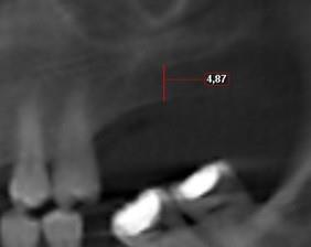 Maksiller posterior bölgede diş eksikliği olan bireylerden; maksiller sinüs ve alveoler kretleri arasındaki mesafenin ölçülmesi amacıyla konik-ışınlı bilgisayarlı tomografi (KIBT) alınarak
