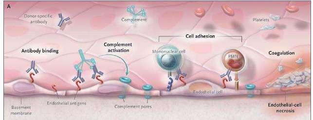 Antibody Mediated Reject Antikor aracılı rejeksiyon