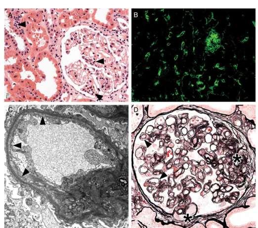 İntimal fibroz Endotel&AB reaksiyonu CD4d Boyaması peritübüler kapiller