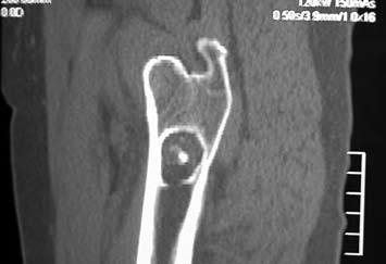 Bu çalışmada, intraosseöz lipoma kalkaneus, humerus veya femur proksimalinde rastladığımız sekiz olgu cerrahi tedavi ve klinik sonuçlar açısından değerlendirildi.