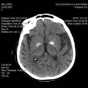 Atipik nörolojik bulgular ile seyreden nadir bir hastalık: Fahr Hastalığı 53 Tablo I.
