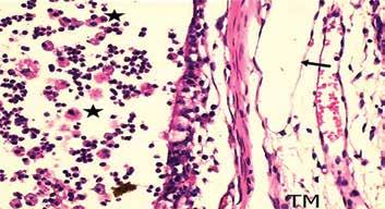 6 Üstündağ et al. Dexamethasone on Preventing Myringosclerosis Resim 4. Çalışma grubundan bir sıçana ait kulak zarı görüntüsü (H&E X 200) : inflamasyonlu alanlar; TM: timpanik membran Tablo 4.