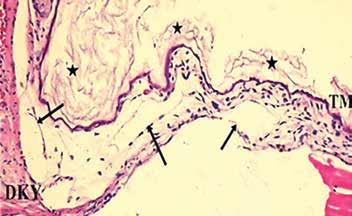 039 *Mann-Whitney U test İnflamasyon Histolojik incelemeye alınan tüm gruplardaki sıçan timpanik membranları inflamasyon açısından değerlendirildiğinde; çalışma grubunda 10 kulağın sekizinde (%80),