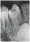 Olgu 3 Klini imize a r ikayeti ile ba vuran 10 ya ndaki erkek hastan n üst sol birinci küçük az di inde derin dentin çürü ü oldu u saptanm t r.