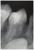 Resim 7: Olgu 3 ün tedavi öncesi al nan periapikal Radyografik ve klinik muayene sonucunda akut apikal periodontitis te hisi konmu ve Resim 8: Olgu 3 ün tedavi sonras al nan periapikal Hastan n bir y