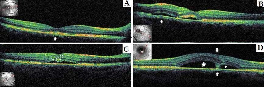 Resim 2. Optik koherens tomografi görüntüleri. Fotoreseptör dış segmentlerinde silinme ve RPE düzensizliği (ok) (A). Sığ seröz foveal dekolman ve yaygın RPE düzensizliği (ok) (B).