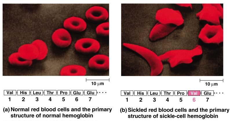 Normal kırmızı kan hücreleri Orak hücre anemisinde eritrositin bikonkav biçiminden orak şekline değişimi gerçekleşir.