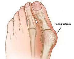 Halluks ayak başparmağı, valgus ise eğri, düz olmayan anlamlarından gelen halluks valgus; başparmağın anatomik bozukluğunu ifade eder.