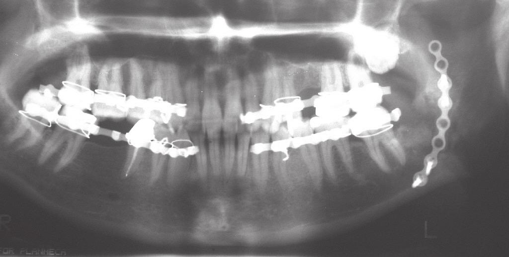 91 RESİM 1 Olgu I gömülü yirmi yaş dişinin çekim öncesi panoramik görüntüsü RESİM 4 Olgu I postoperatif 1.