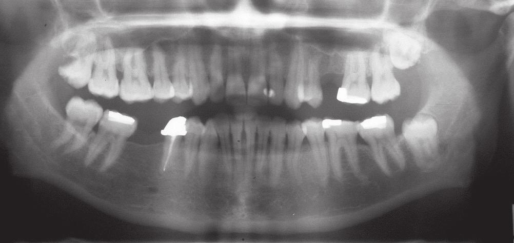 Operasyonda dişin tek parça olarak çıkarıldığı, intraoral muayenede ağız açıklığında ağrılı limitasyon, kırık fragmanlarının minimal dislokasyonuna bağlı sol taraf posterior dişlerde