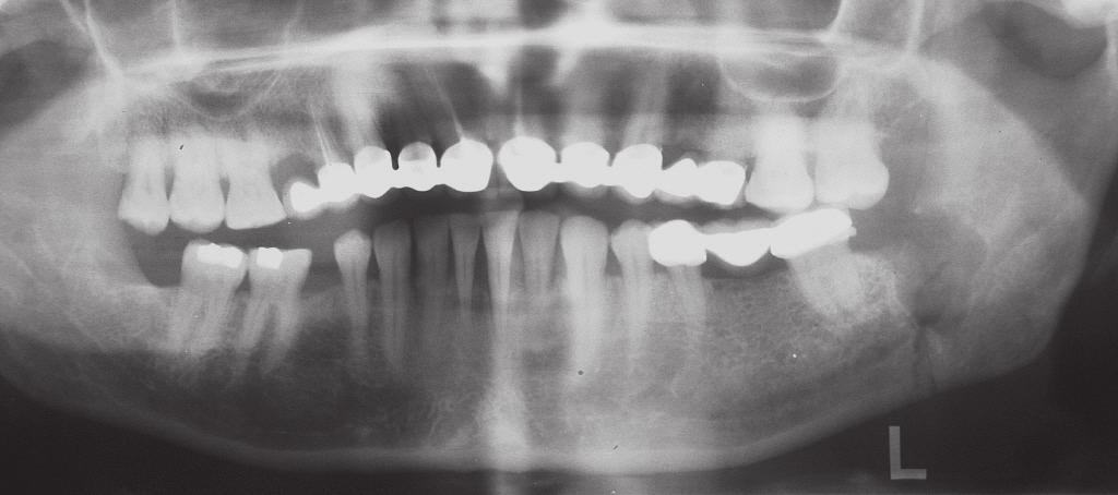 Perry ve Goldberg 106 oral ve maksillofasiyal cerrahın son 10 yıl kayıtlarında gömülü yirmi yaş dişi çekimleri sırasında ve sonrasında mandibula fraktürü gelişme riski ve etkenlerini araştırdıkları