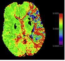 Perfuzyon weighted imaging (PWI) Tek başına kullanımı sınırlıdır.