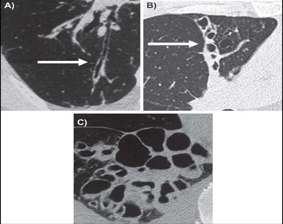Şekil 1: Reid sınıflandırmasının YÇBT görüntüleri A) Tübüler bronşektazi B) Variköz bronşektazi C) Kistik bronşektazi (14).