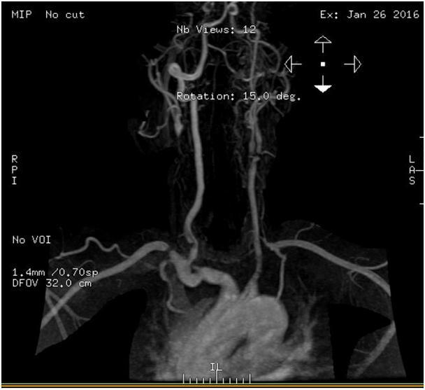 Memmodova ve ark. Resim V. MRA da, sağ CCA ve ICA nın servikal Resim VI. DSA da sağ subklavyen arter ve sol ICA ve sol ECA bulbusunda kritik segmentinde total akım kaybı, Sağ subklavian arter stenoz.