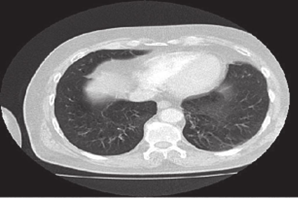 Hastanın eski görüntülemesinde bahsedilen sol akciğer alt lobdaki nodülün olmadığı, diğer bulguların ise aynı şekilde izlenmekte olduğu dikkati çekti (Resim 2).
