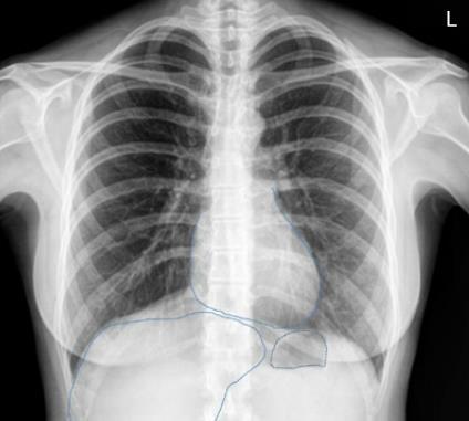Akciğer radyogramı nasıl okunmalı?