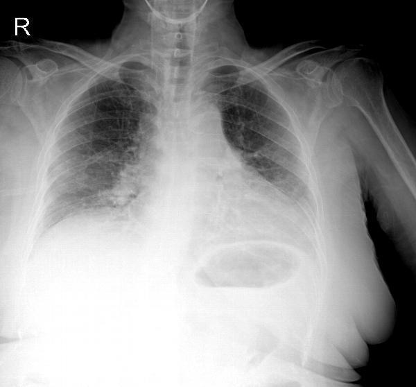 79 yaşında kadın hasta Göğüs ağrısı ve nefes darlığı şikayetleri ile acil