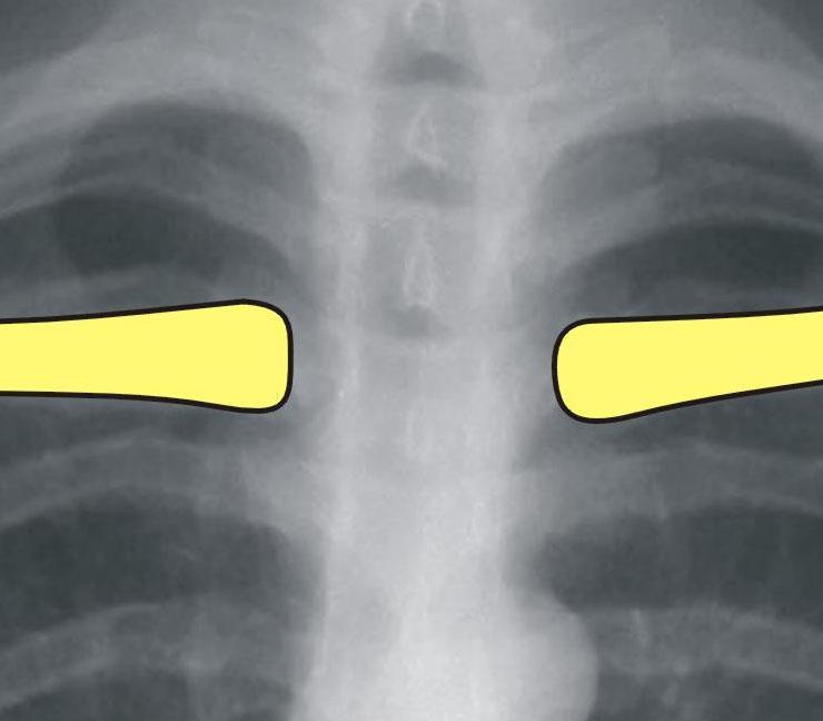 Teknik olarak kabul edilebilir PA akciğer grafisi Simetri: klaviküla