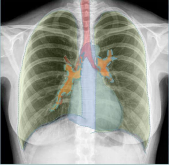 Akciğer grafisi belirli bir sıra ile değerlendirilmeli Trakea Kalp ve mediasten