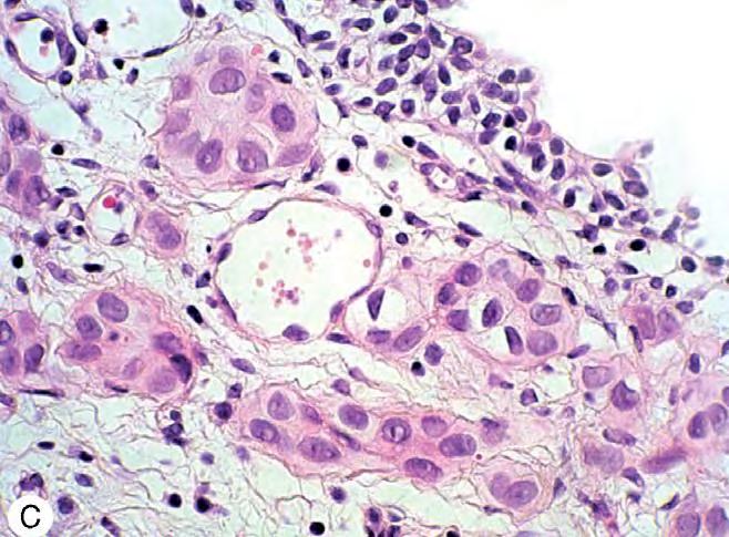 Ayırıcı tanı: Von Brunn hiperplazisi Paraganglioma