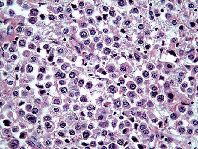 Plazmasitoid İnvaziv tm içinde % 2,7 AT: Multipl myelom / lenfoma,