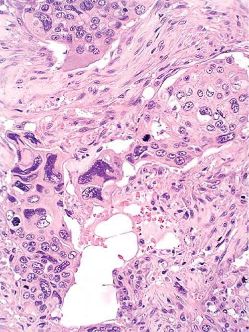 Trofoblastlar içeren Ürotelyal Karsinom AT: Osteoklastik dev hücreden zengin ÜK Metastatik germ hücreli tümör, koryokarsinom