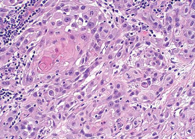 Akciğerin dev hücreli karsinomuna benzer AT: Metastatik