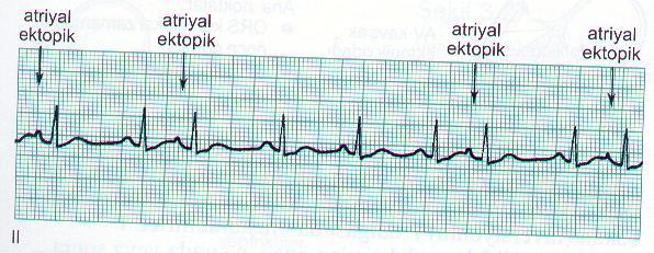 Premature Atrial Kontraksiyon Ektopik bir atrial odaktan kaynaklanır. Normal bir sinüs ritmi varlığında görülür.