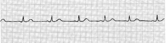 Normal Sinüs Ritmi EKG özellikleri; Belirgin olarak izlenebilen P dalgaları olmalı P dalgalarının morfolojileri aynı olmalı Her P dalgasını bir QRS