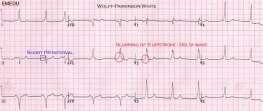 Geniş Kompleks Taşikardi Eğer hasta anstabilse VT olarak değerlendirilmeli ve acil KV yapılmalıdır Eğer hasta stabil ise 12-lead EKG çekilir QRS genişliğine bakılır Bu noktada konsültasyon istenir