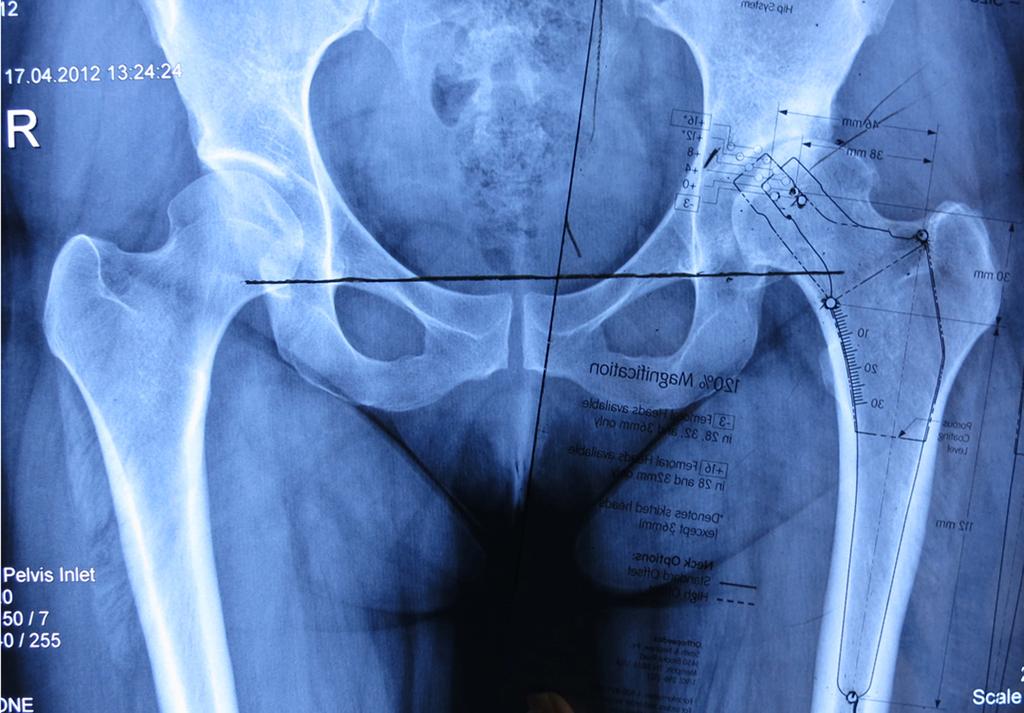 referans çizgi (B B ), Asetabulumun superolateral kenarı (C). Şekil 2.