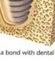 d Diş hekimliğinde implantasyon