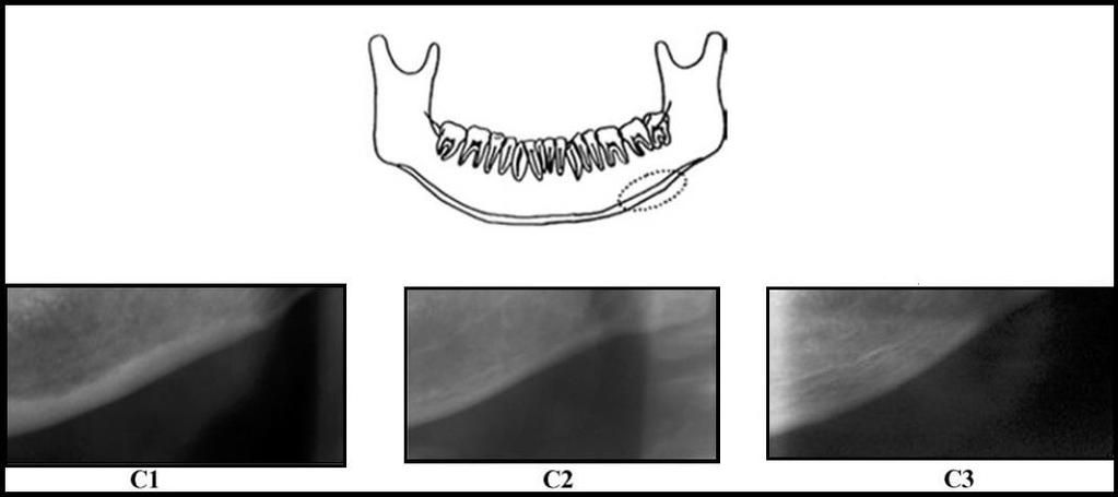 2.8 Mandibular Kortikal İndeks Mandibular kortikal indeks (mandibula alt kenarının görünürlüğü), Klemetti ve ark na (1993) göre