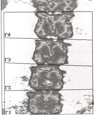 Ekim-Aralõk 2000 KEMİK MİNERAL YOĞUNLUĞU; DEMİR VE ARK. 199 Şekil 4. Sol femur DEXA görüntüsü. Kemik mineral yoğunluğu femur boynundan alõnmõştõr Şekil 3. Lomber vertebra DEXA görüntüsü.