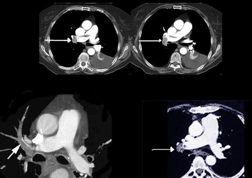 BT angiografi görüntüleri BT Angiografi Tanı değerliliği yüksektir. Ayırıcı tanıda da kullanışlıdır Kreatinini yüksek olanlarda dikkat edilmelidir. PE tanısında sintigrafinin yerini almıştır.